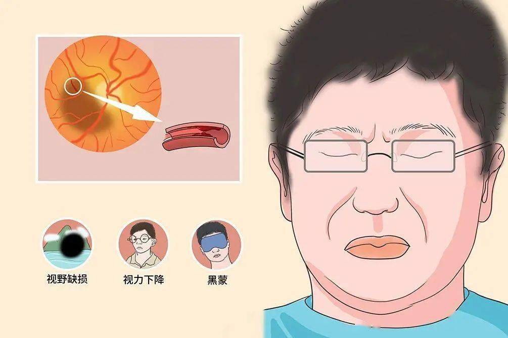 可怕一男子突发眼中风左眼基本失明