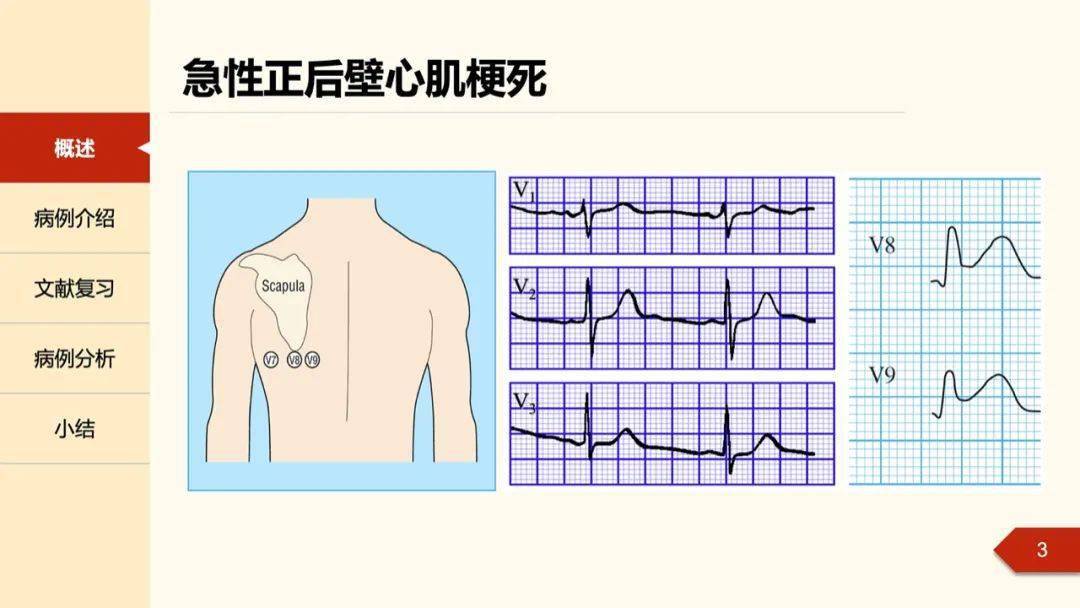 孔令秋教授正后壁心肌梗死的定位困惑及心电图线索