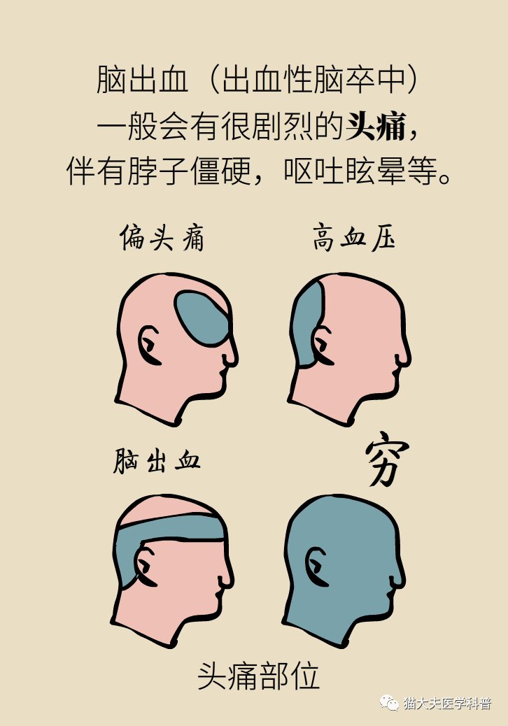 冬季脑卒中高发,新救命手段"取出血栓"了解一下