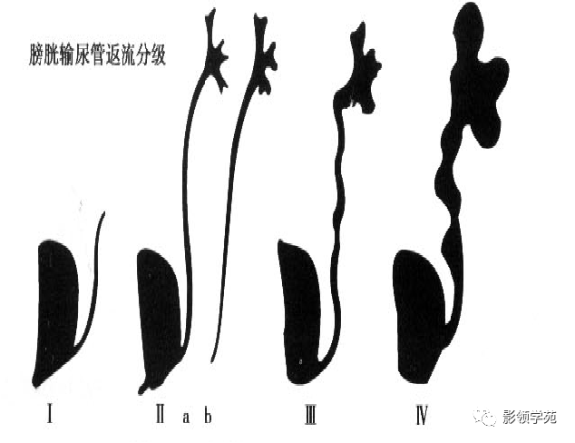 輸尿管先天畸形影像表現