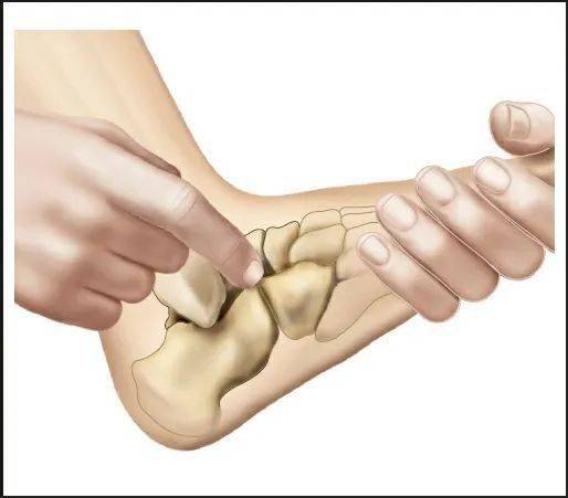 治疗师将受检者足部压向近端(朝着足跟)可以触到跗骨窦或者跗骨管