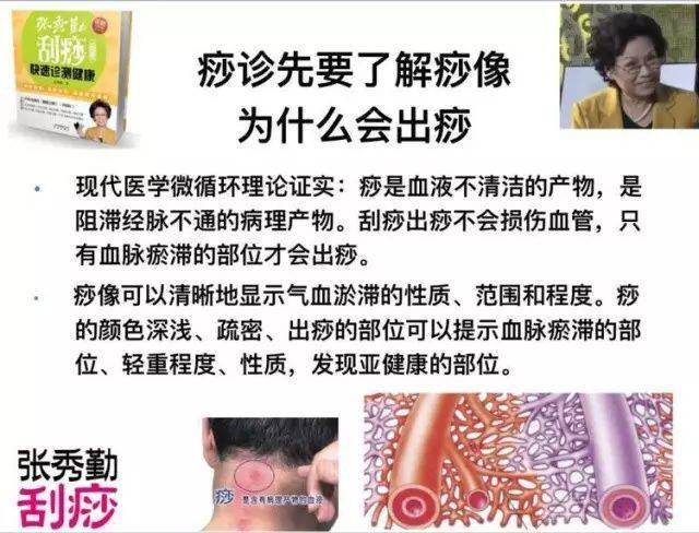 文稿对照前500名,赠送30天线上带教打卡学习(仅剩最后200席)痧是什么?
