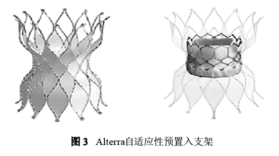 經導管肺動脈瓣置換術的新器械與新技術進展