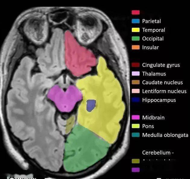 軸 位cerebellum posterior lobe 小腦後葉cerebellum anterior lobe