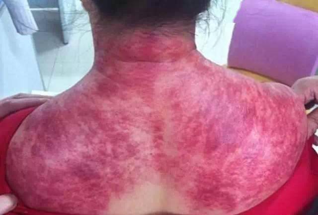 肩颈是毒素最易堆积的地方不疏通就是这样子