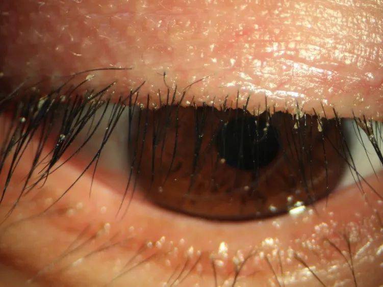 分泌物睑缘充血,眼红倒睫麦粒肿,霰粒肿睑板腺开口隆起角膜疤痕引起