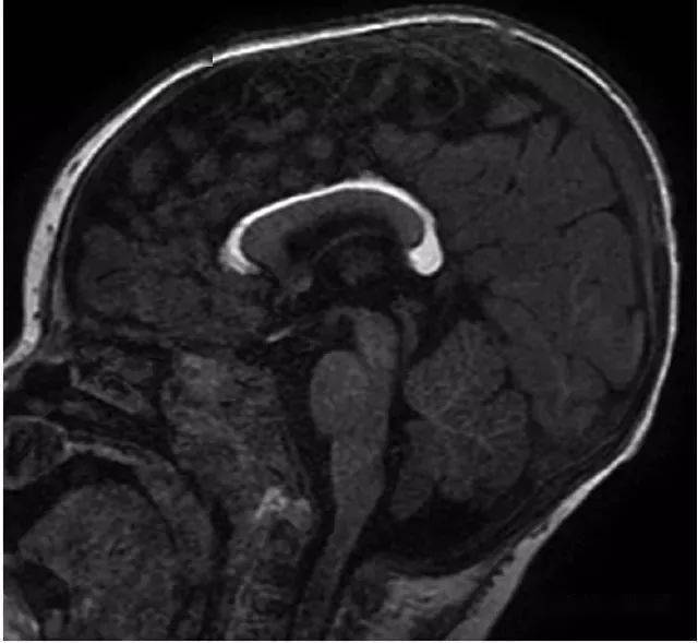 大脑中线处常见的25种疾病
