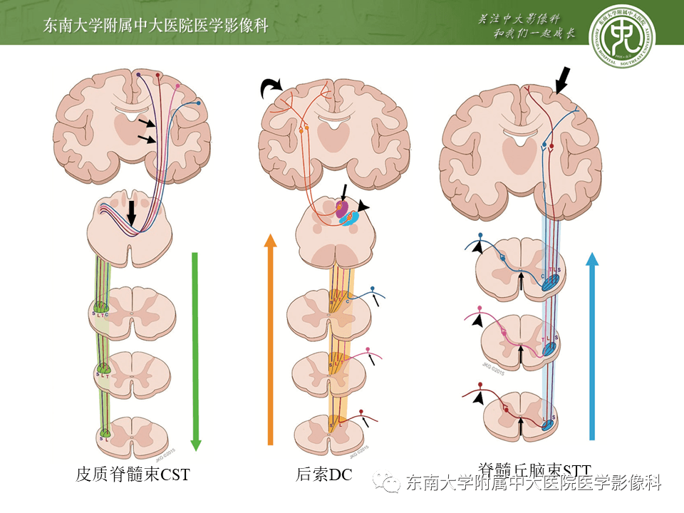 脊髓亚急性联合变性