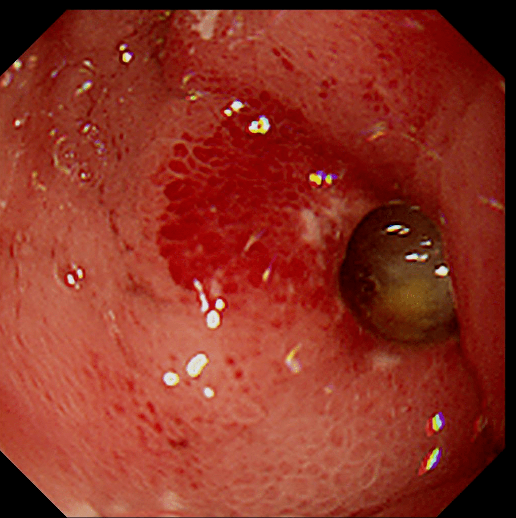 可以直视观察溃疡,也可以进行活检,并根据病理检查结果作良恶性的鉴别