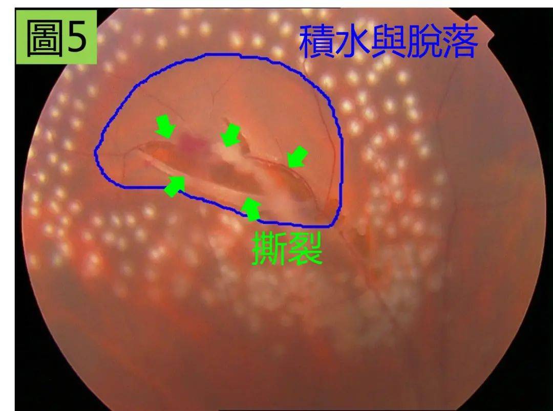 拉久了或拉破了,就可能并发视网膜脱落或穿孔