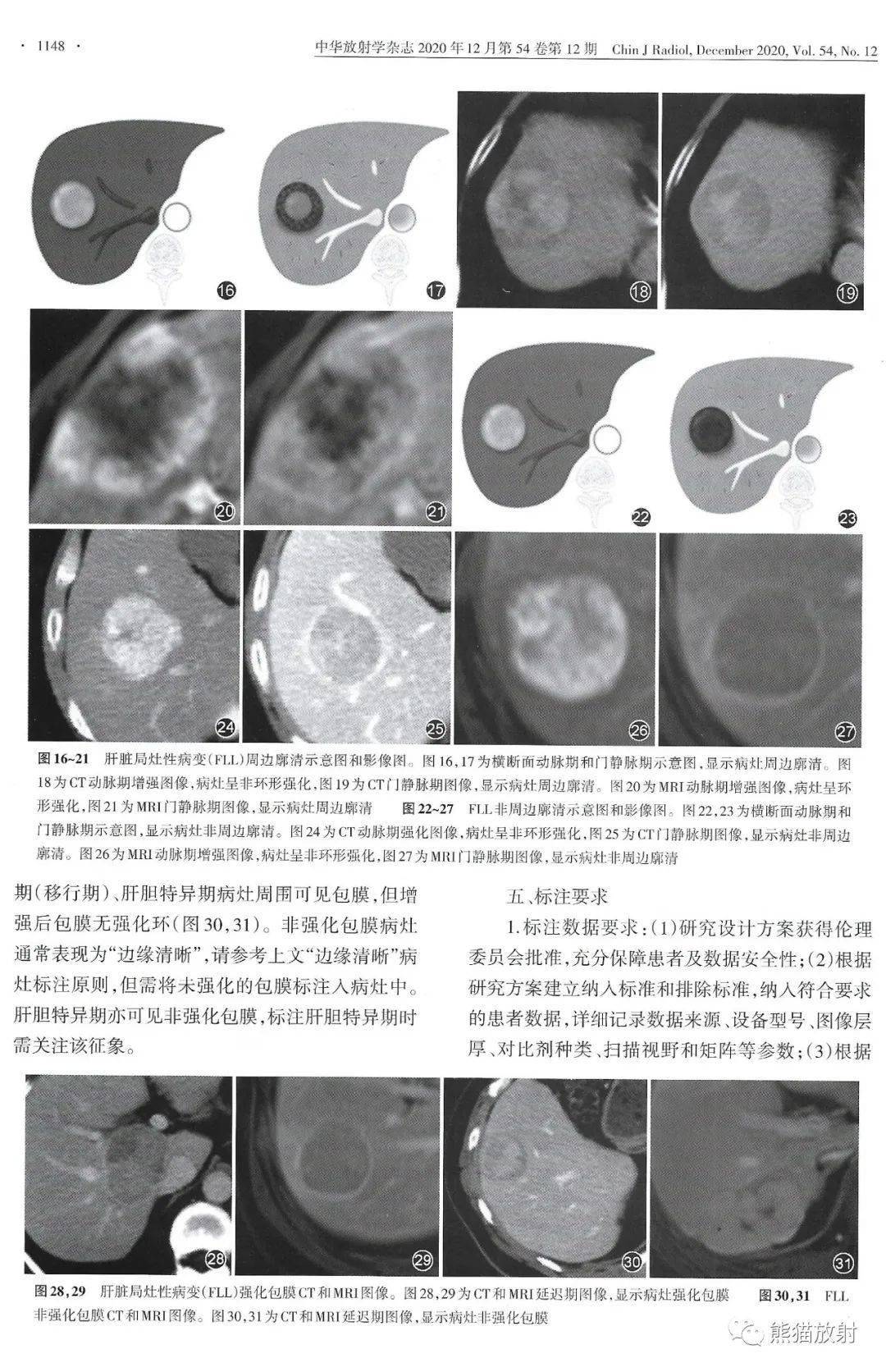 规范与共识丨肝脏局灶性病变CT和MRI标注专家共识(2020)_分类