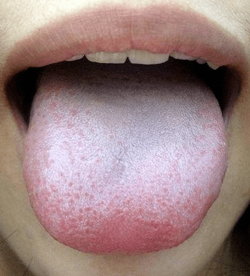 出现舌体胖大,两边有齿痕的齿痕舌,湿重的人,有的舌相呈明显的水滑苔
