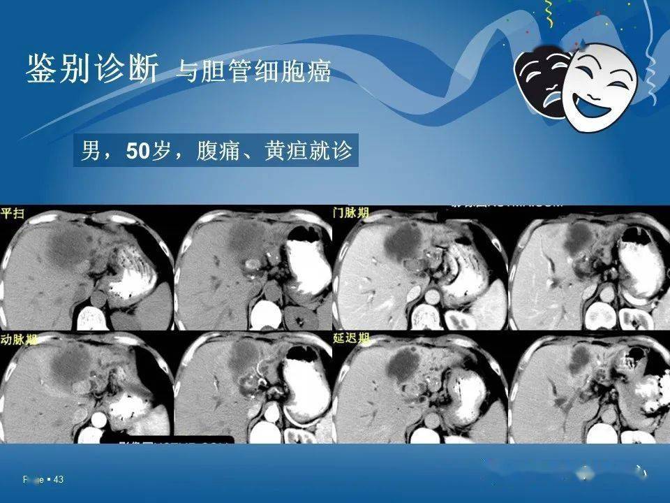原发性肝细胞癌的ct和mri诊断