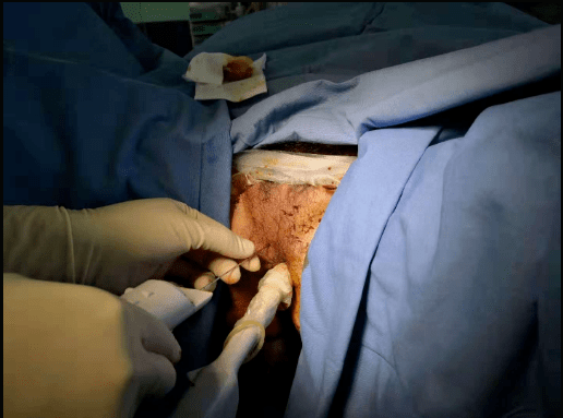 成功为3位患者实施了b超引导下经会阴前列腺穿刺活检术,手术过程顺利