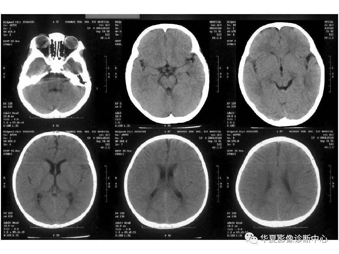 收藏影像医生必备手把手教你读懂颅脑ct
