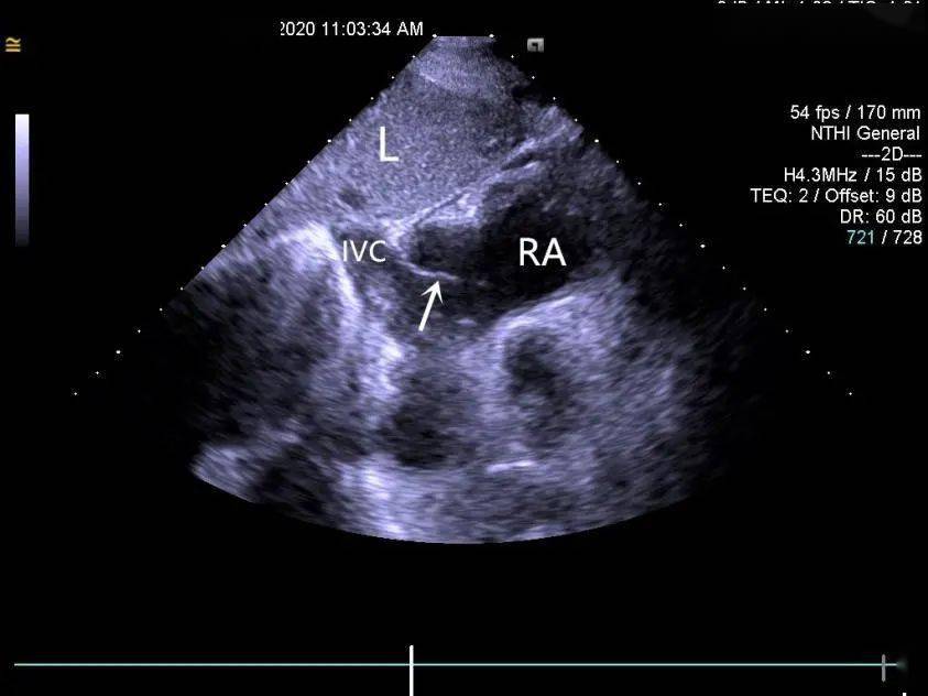 ra 右心房 l 肝脏 ivc 下腔静脉)3,冠状窦瓣在心脏胚胎发育过程中