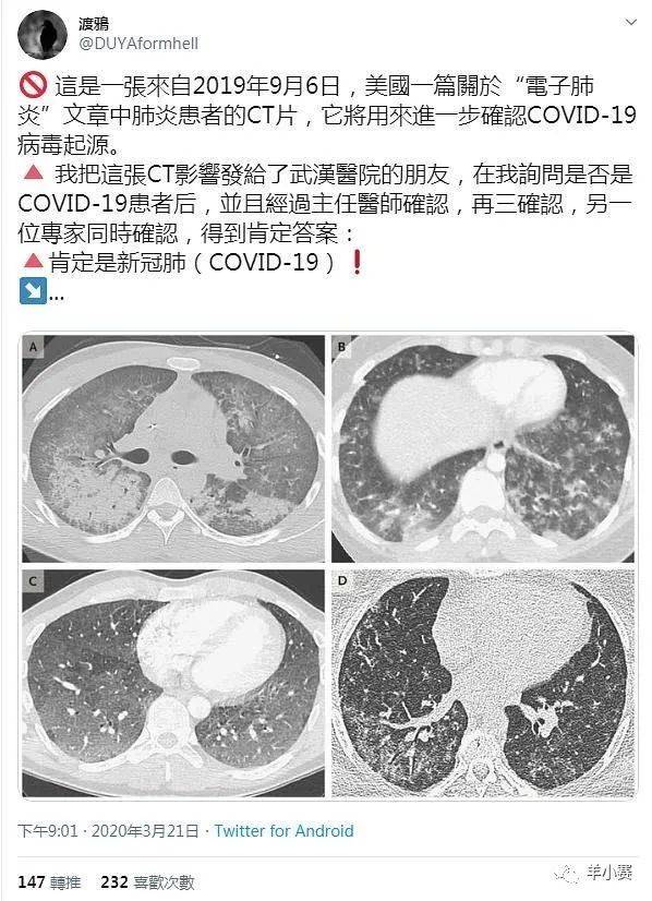 美国人口感染肺炎_美国新冠肺炎大舌头