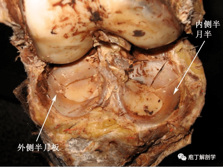 半月板: 有內側半月板和外側半月板.