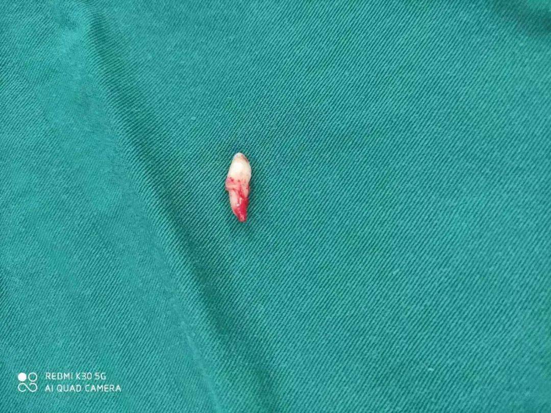 罕见!7岁患儿上腭竟长出"萝卜"样牙齿 这件事家长莫忽视