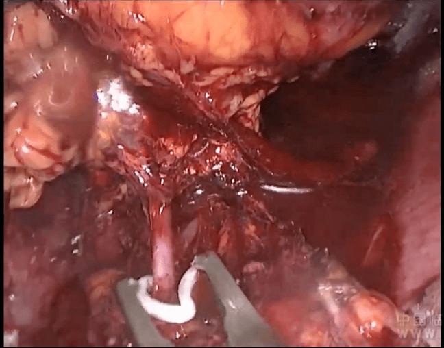 手术演示丨腹腔镜左侧肾上腺切除术