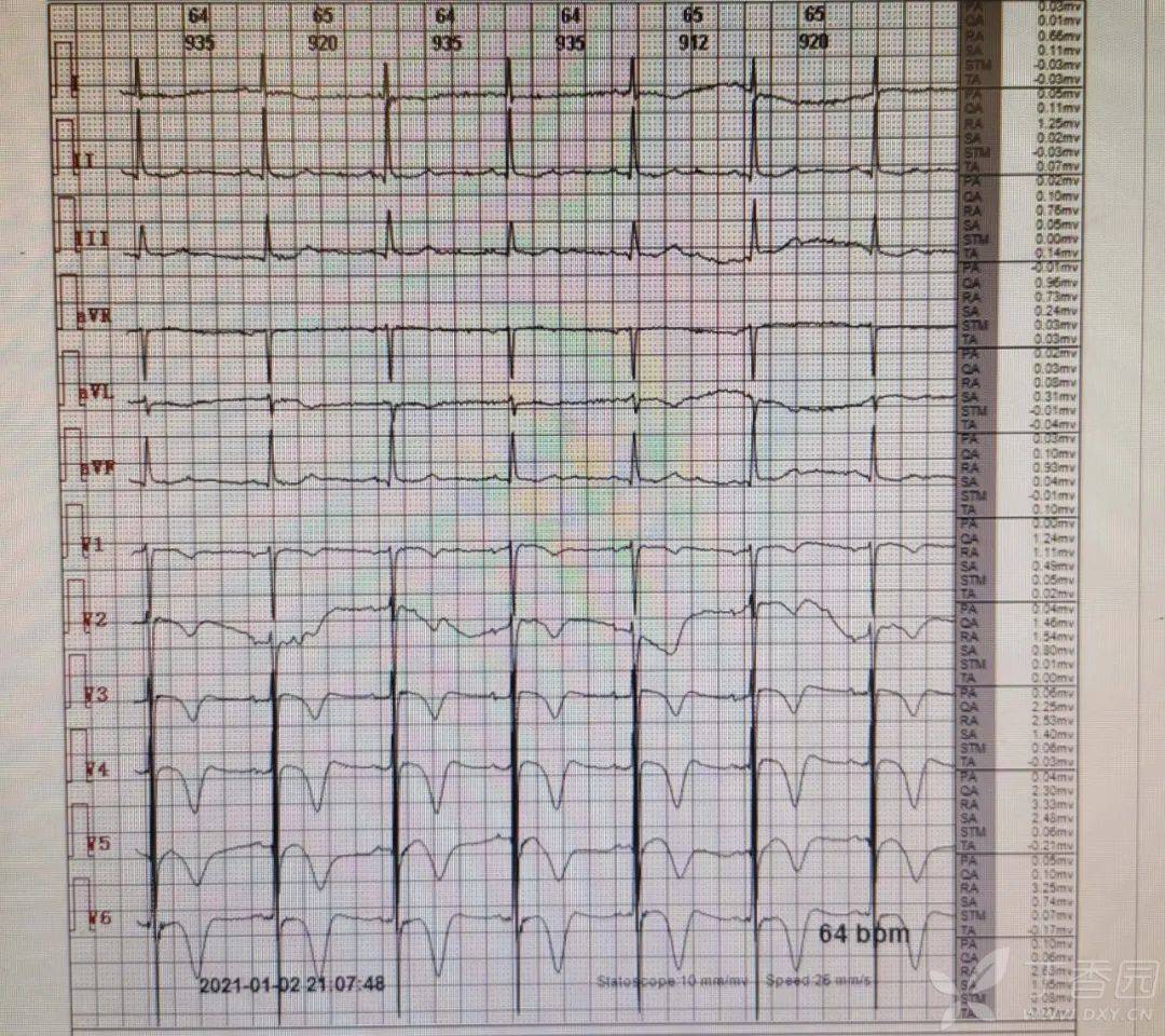 典型病例,看心電圖動態演變 | 達摩心電圖專欄