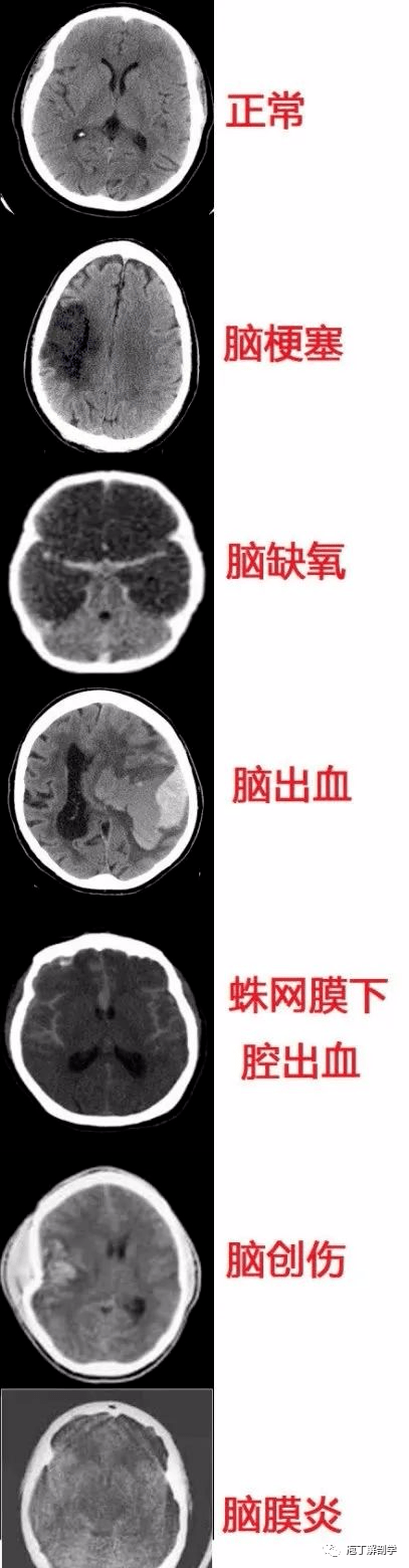 最全神经系统及神经疾病解剖图收藏版