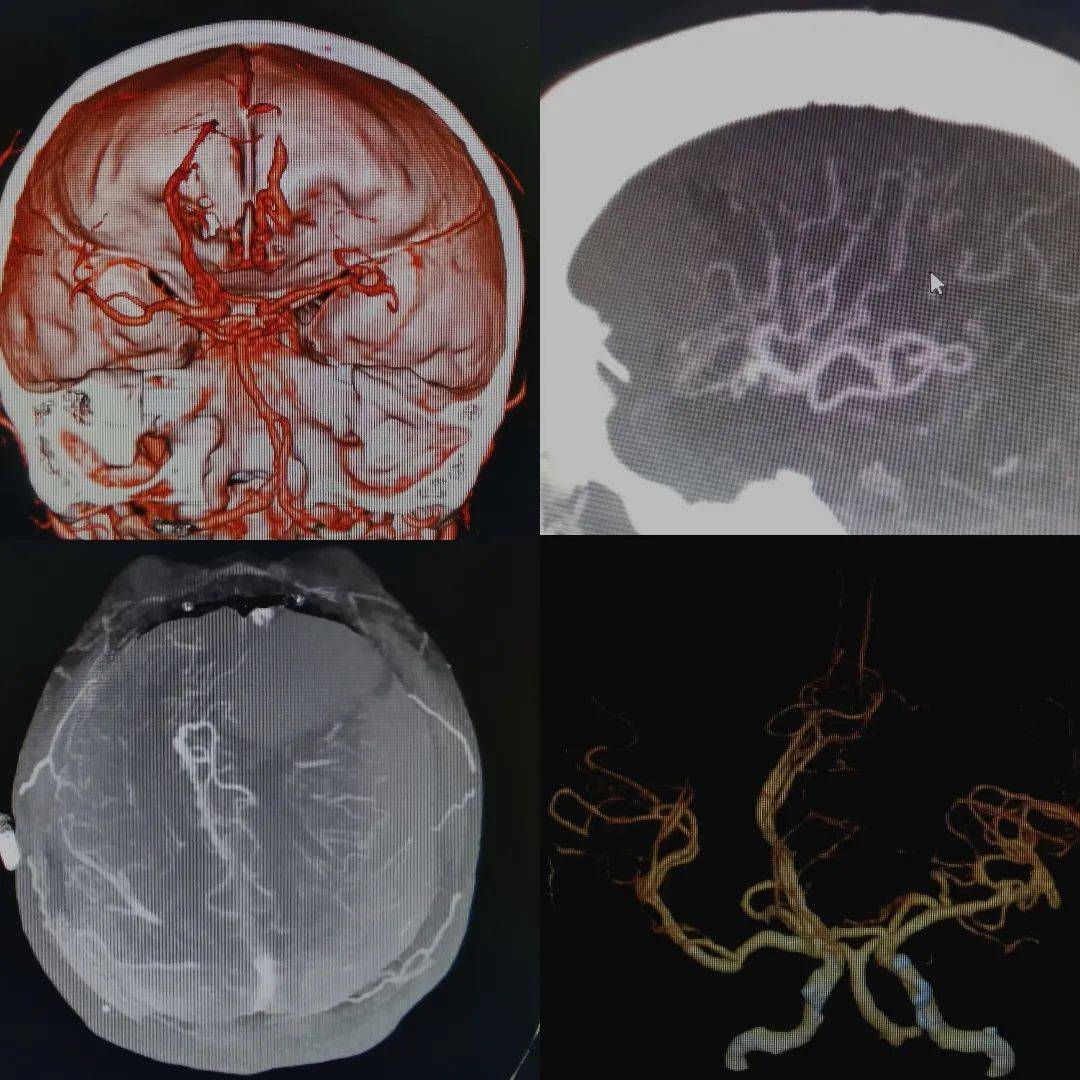 【头条】锡市一七旬老人颅内出血,生命垂危
