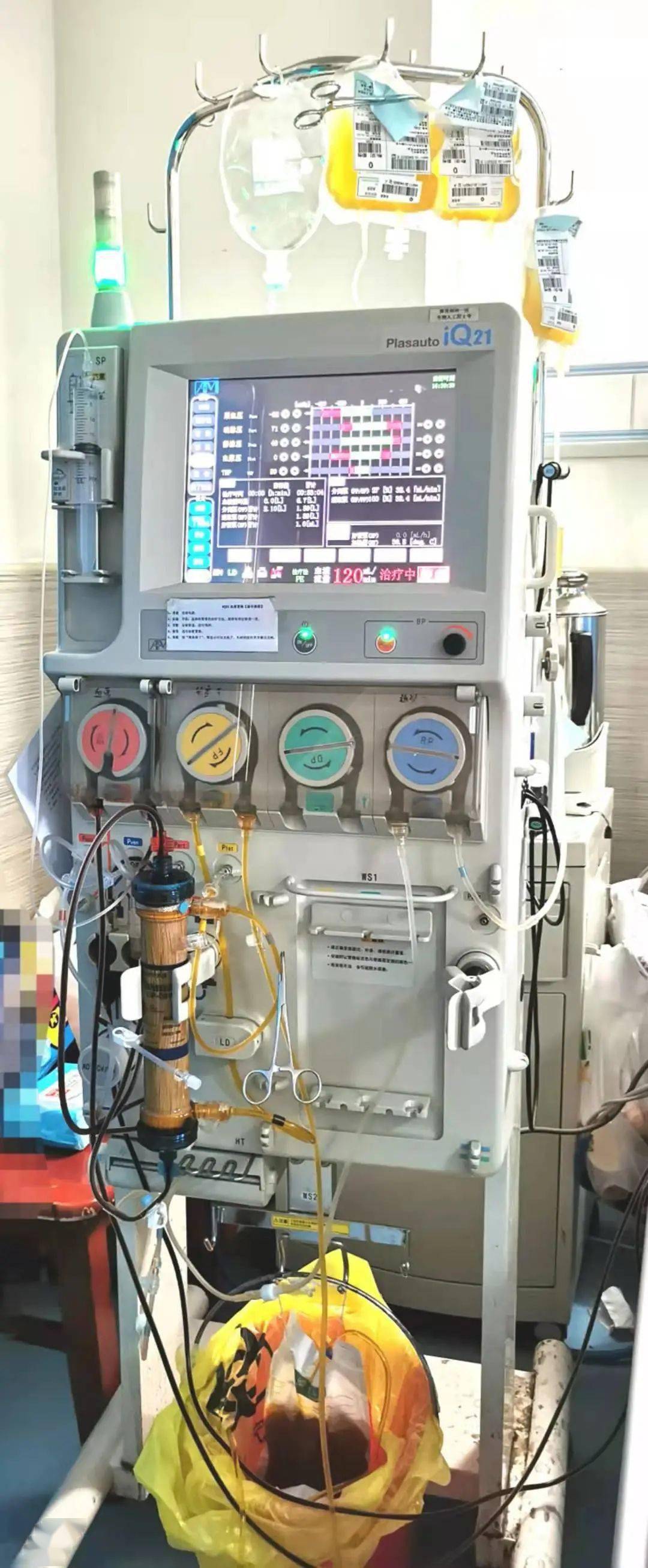 【知多d】血浆置换治疗肝功能衰竭