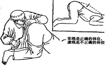 核酸肛拭子采样示意图网友们羞涩了