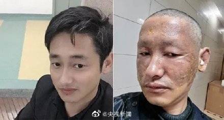 辅警救火被炸伤近乎毁容（图）