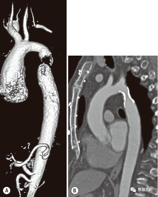主动脉迂曲x线图片图片