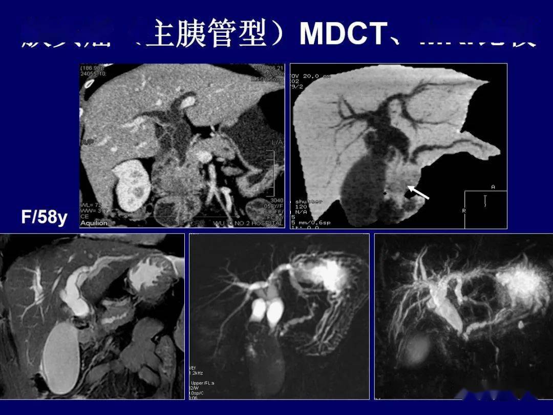 壶腹周围癌图片