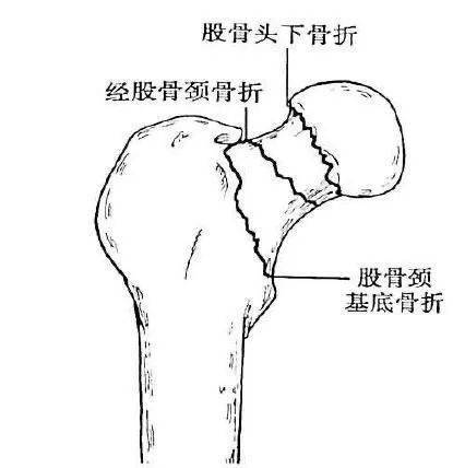 自由下肢骨股骨