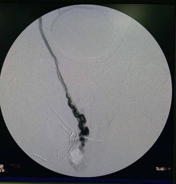 右侧精索静脉术后造影