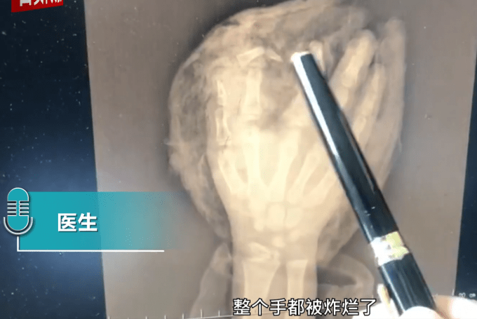 长沙8岁男童捡烟花燃放手被炸烂，骨头外露，画面令人心痛！