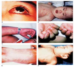 突破传统挣脱束缚川崎病治疗新纪元之英夫利昔单抗