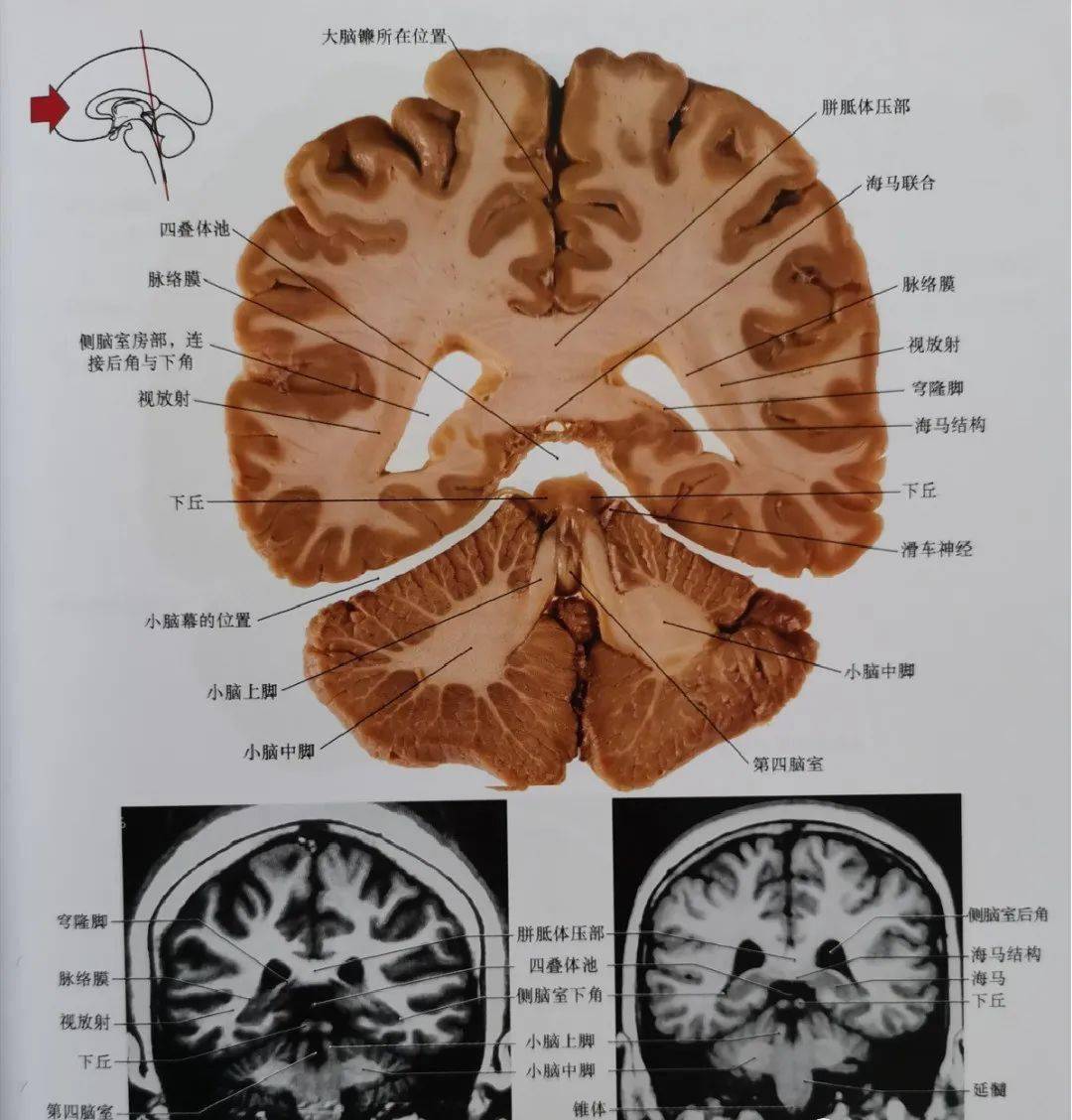图8 通过胼胝体压部,四叠体池的尾部,侧脑室三角区,小脑上脚,小脑中脚