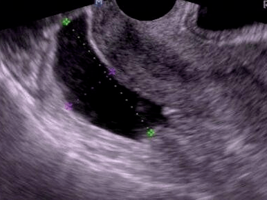阴超盆腔积液图片