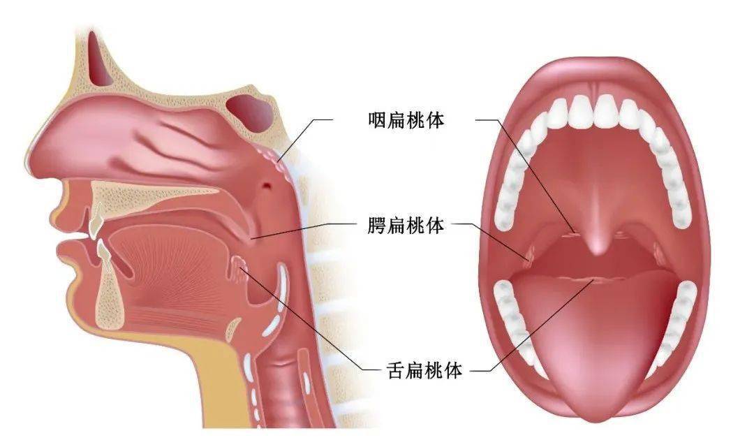 右扁桃体发炎怎么办