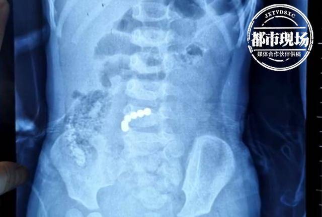 又是磁力珠!2岁女孩频频腹痛,医生一查发现肠子已经穿孔