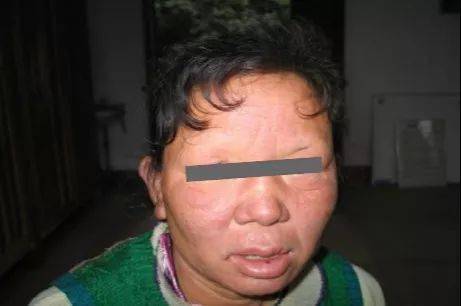 麻风病患者典型症状——酒醉面容麻风病虽然很少引起死亡,但可致皮肤