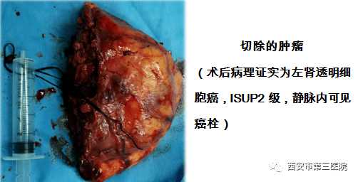 排雷专家一例局部晚期肾癌的救治