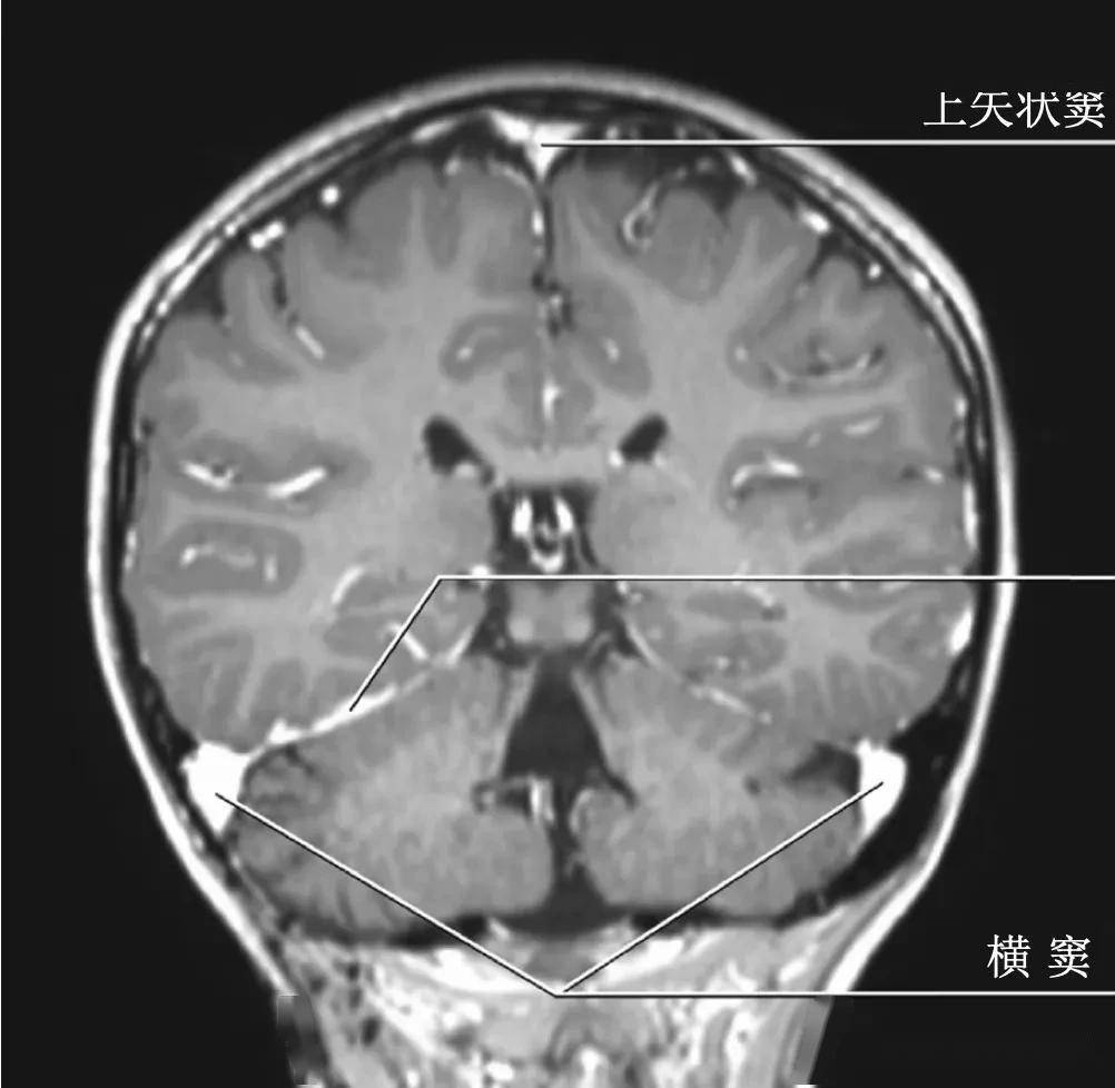 一般情况下,上矢状窦的血液流向右侧横窦,而直窦的血液流向左侧横窦