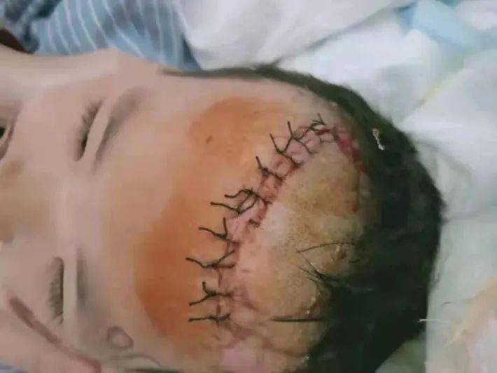 峡山五岁小孩遭遇车祸受伤严重