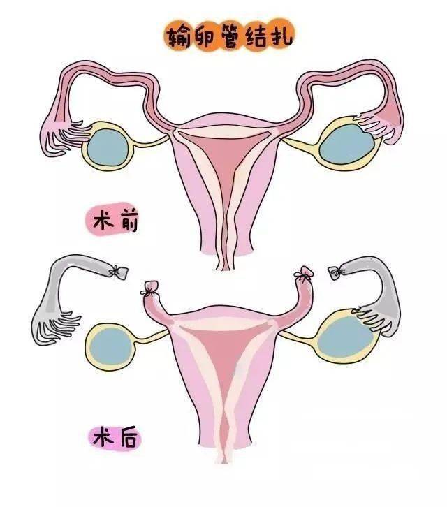 我是個直男24歲做了絕育手術廣東男子心疼女友選擇結紮