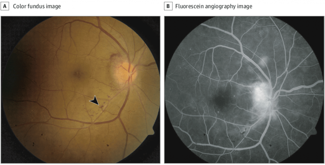 双眼矫正视力20/20,双眼瞳孔,色觉和眼前节检查正常,右眼眼底可见视盘
