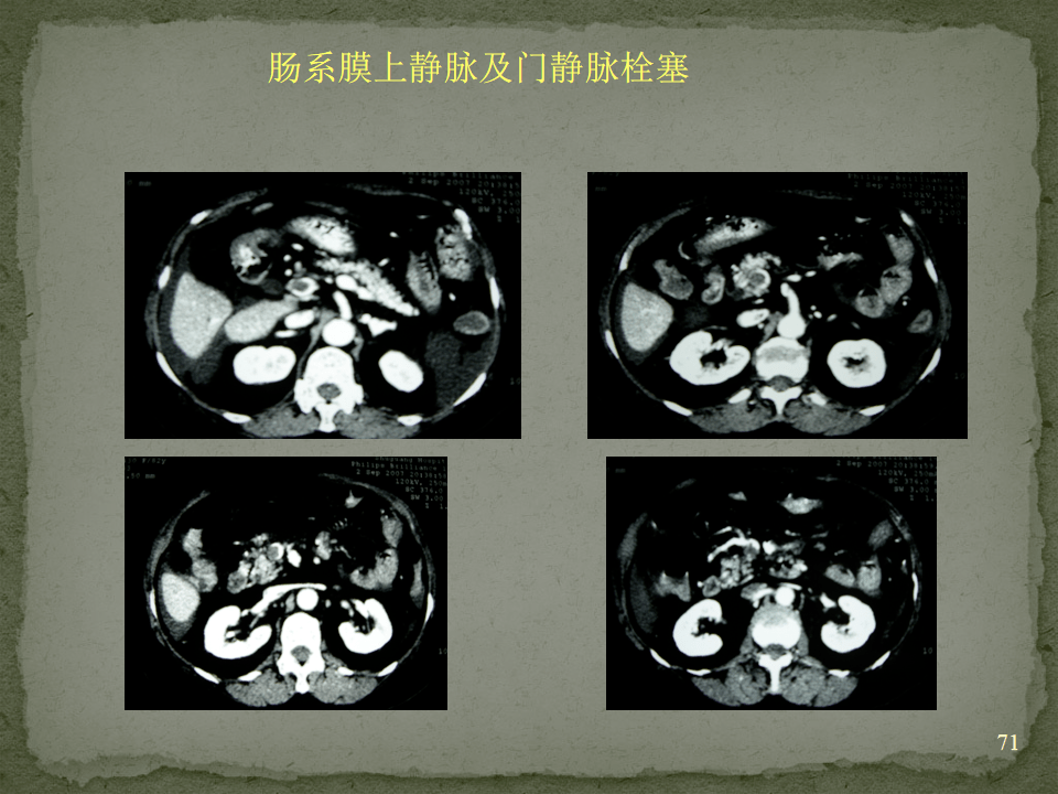 小腸擴張大於3cm,結腸擴張大於7cm;3~6小肘出現x線徵;小腸弓形腸曲