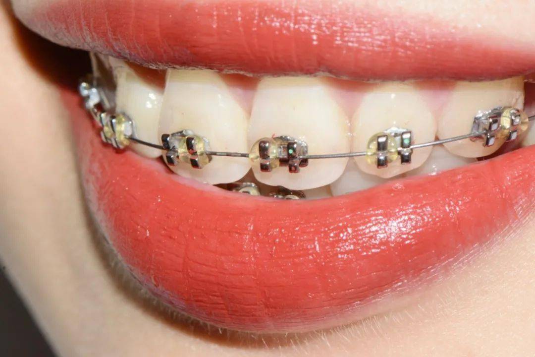 1, 普通金属托槽矫正tsk dental固定矫正常见的牙齿矫正技术通过牙齿