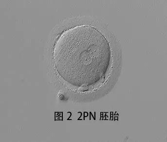 【生殖吧】試管嬰兒:胚胎受精情況解讀_精子