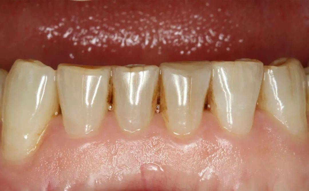 临床先锋舌侧贴面修复下前牙切端缺损一例